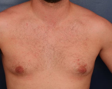 Before Image: Gynecomastia - front