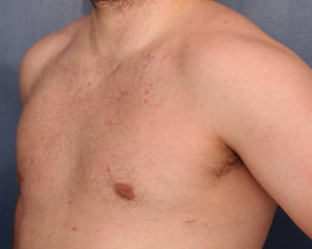 After Image: Gynecomastia - left-front-oblique