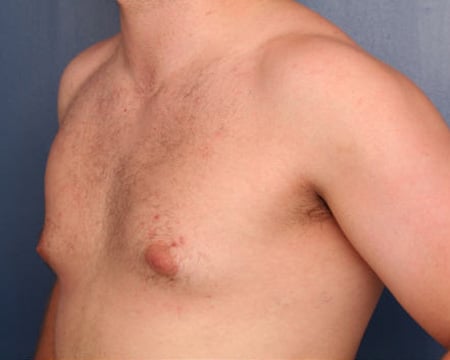 Before Image: Gynecomastia - left-front-oblique