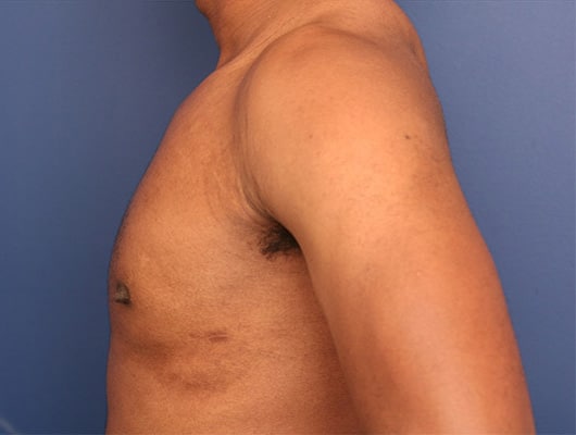 After Image: Gynecomastia - left-side