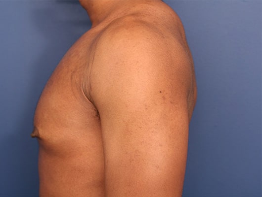 Before Image: Gynecomastia - left-side