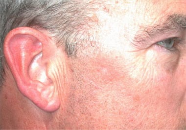 After Image: Intense Pulsed Light - right-front-oblique