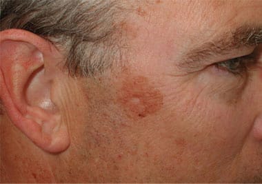 Before Image: Intense Pulsed Light - right-front-oblique