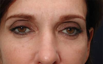 After Image: Intense Pulsed Light - front
