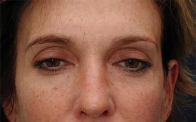Before Image: Intense Pulsed Light - front
