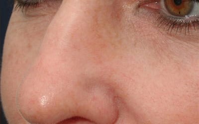 After Image: Intense Pulsed Light - left-front-oblique
