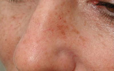 Before Image: Intense Pulsed Light - left-front-oblique