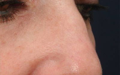 After Image: Intense Pulsed Light - right-front-oblique