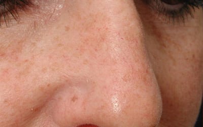 Before Image: Intense Pulsed Light - right-front-oblique
