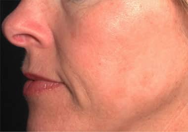 After Image: Intense Pulsed Light - left-front-oblique
