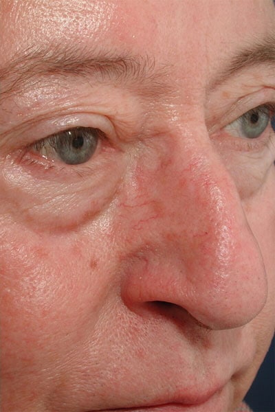 After Image: Intense Pulsed Light - right-front-oblique