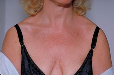 After Image: Intense Pulsed Light - front