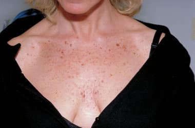 Before Image: Intense Pulsed Light - front