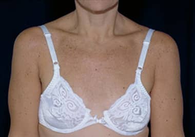 After Image: Intense Pulsed Light - front