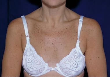 Before Image: Intense Pulsed Light - front