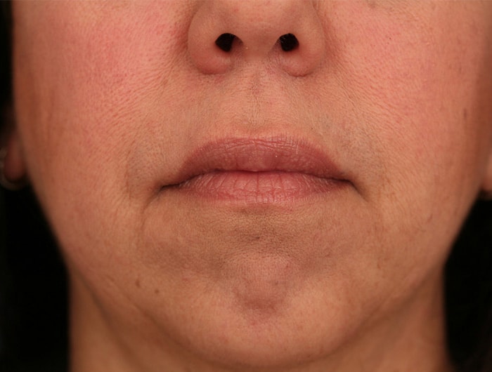 After Image: Juvederm Ultra upper lip and commisures - front