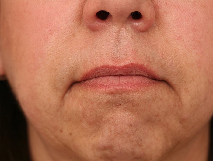Before Image: Juvederm Ultra upper lip and commisures - front