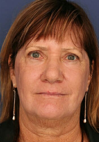After Image: Laser Resurfacing - front