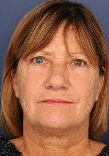 Before Image: Laser Resurfacing - front