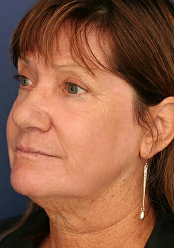 After Image: Laser Resurfacing - left-front-oblique