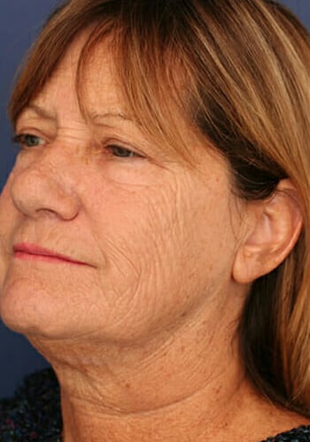 Before Image: Laser Resurfacing - left-front-oblique