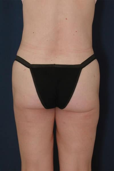 After Image: Liposuction - back