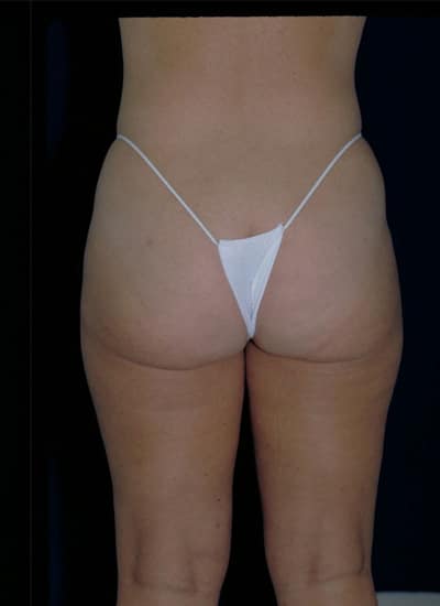 After Image: Liposuction - back