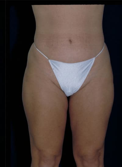 After Image: Liposuction - front