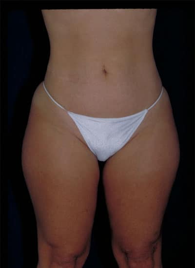Before Image: Liposuction - front