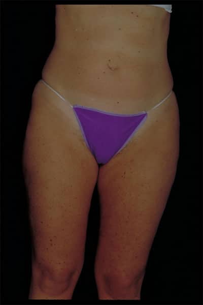 After Image: Liposuction - front