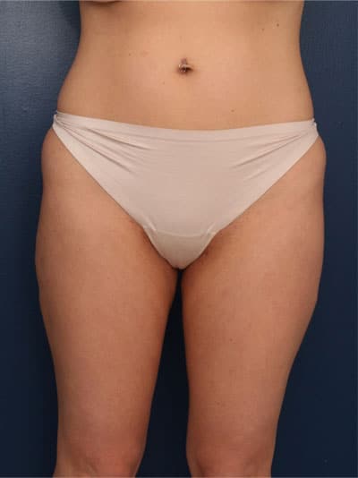 After Image: Liposuction - front
