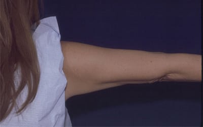 After Image: Liposuction - back
