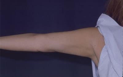 After Image: Liposuction - left-side