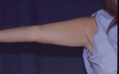 Before Image: Liposuction - left-side