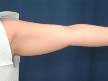 Before Image: Liposuction - front