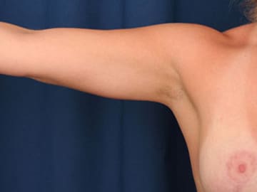 After Image: Liposuction - front