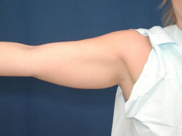 Before Image: Liposuction - front