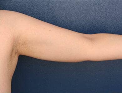After Image: Liposuction - front