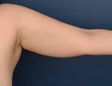 Before Image: Liposuction - front