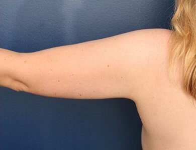 After Image: Liposuction - back