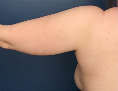 Before Image: Liposuction - back