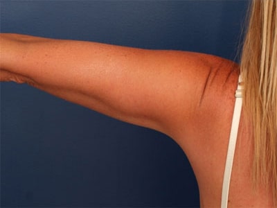 After Image: Liposuction - back