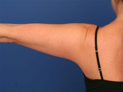 Before Image: Liposuction - back