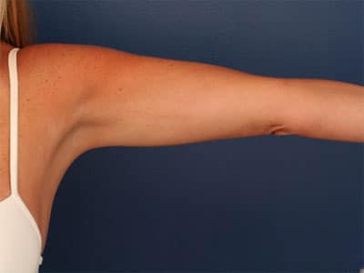 After Image: Liposuction - front