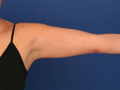 Before Image: Liposuction - front