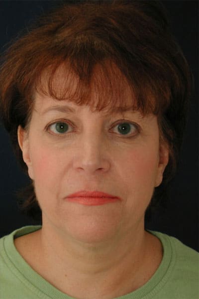After Image: Liposuction - front