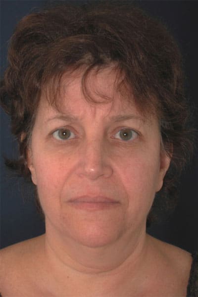 Before Image: Liposuction - front