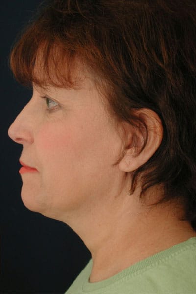 After Image: Liposuction - left-side