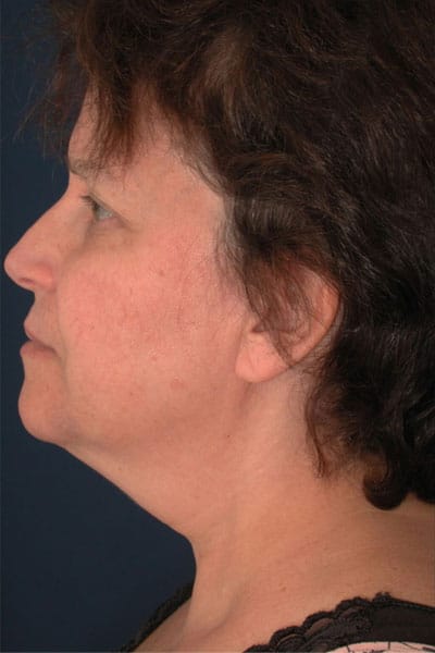 Before Image: Liposuction - left-side