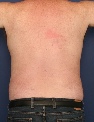 After Image: Liposuction - back